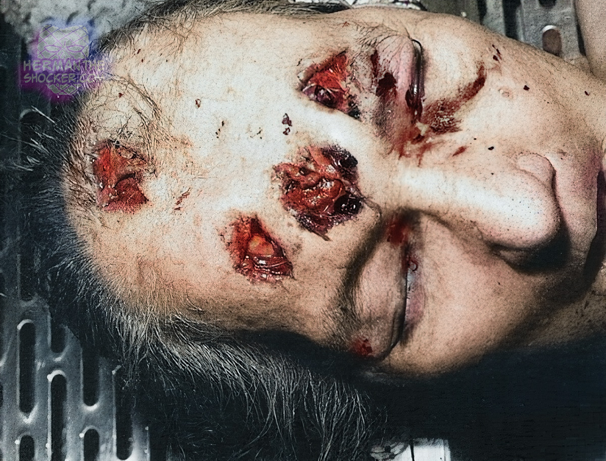 Multiple homicidal lacerations of the scalp