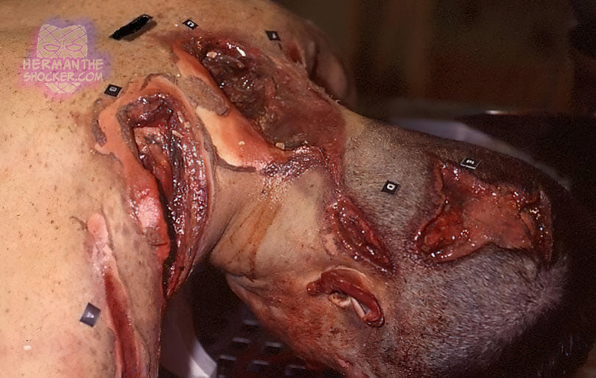 Chop injuries inflicted by a boat propeller