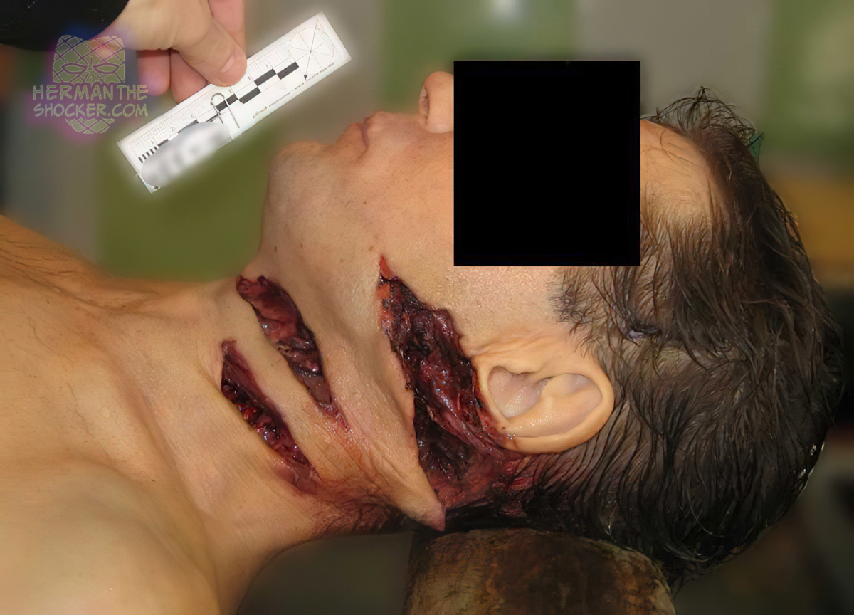 Chopping neck wounds