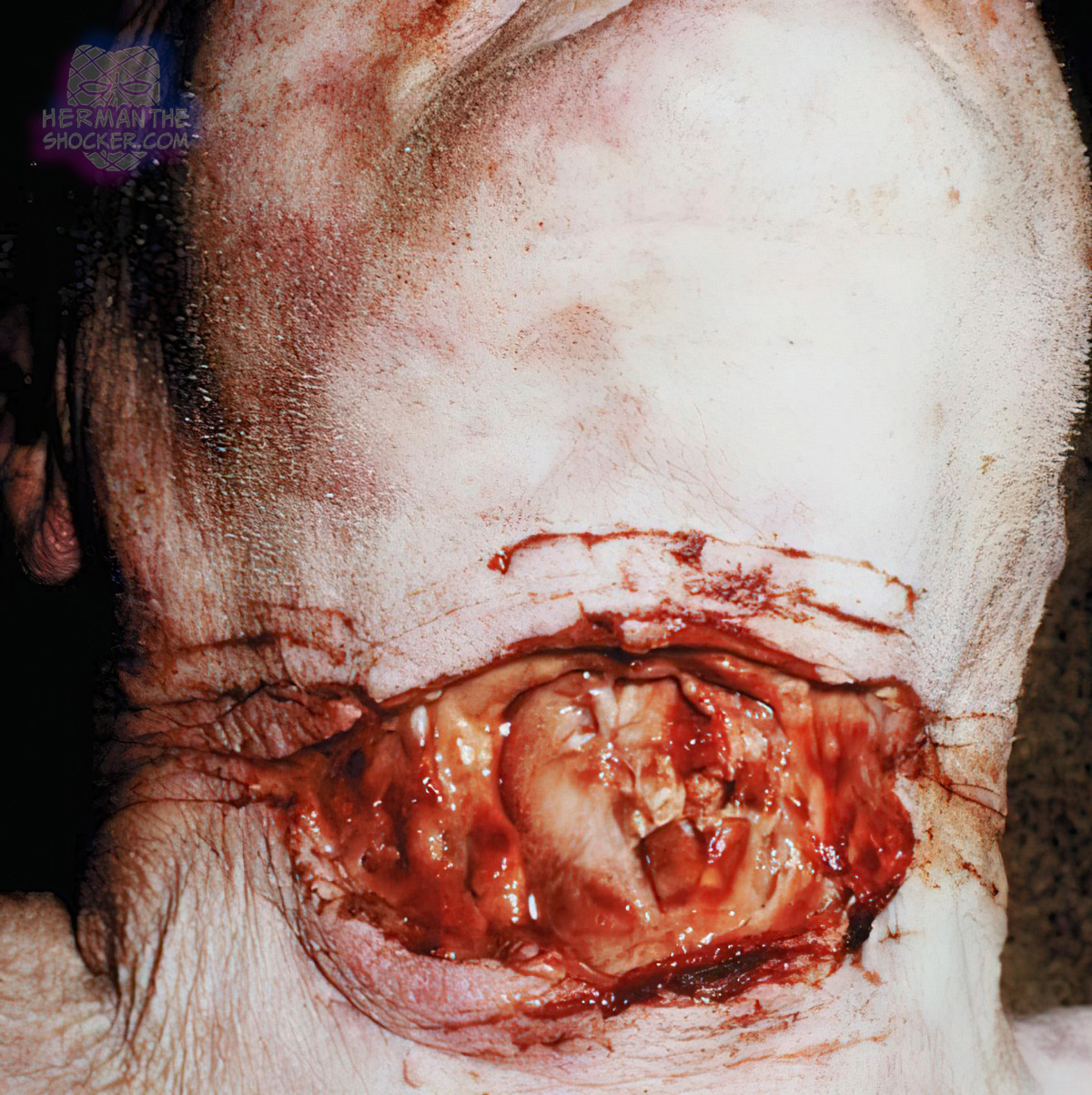 Suicidal cut throat