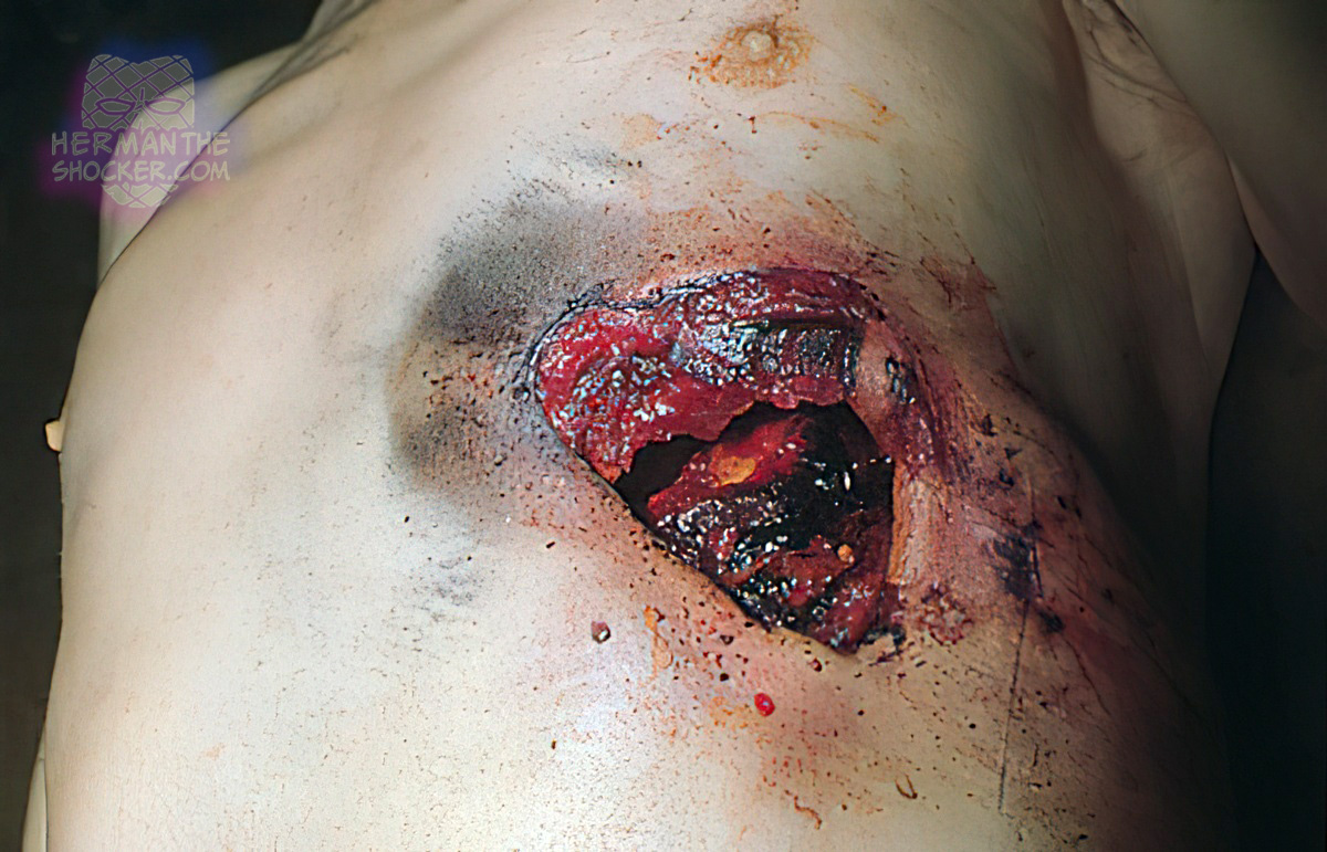 Close discharge of a 12-bore shotgun to the chest