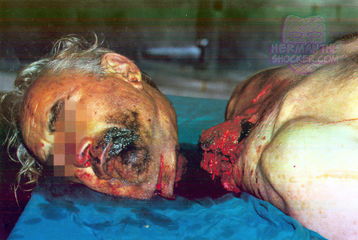 Decapitation of the head from a train suicide