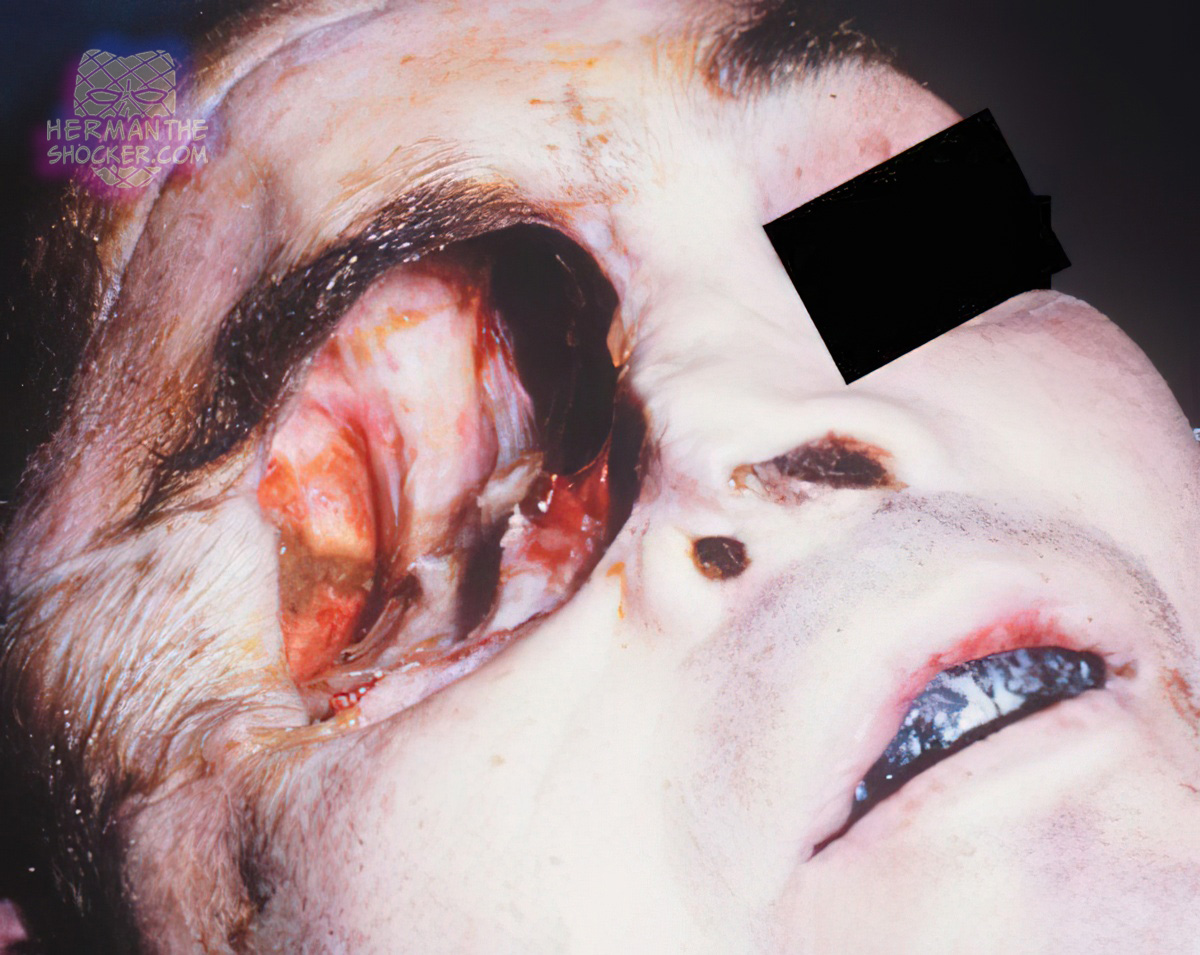 Localized injury by an explosive device
