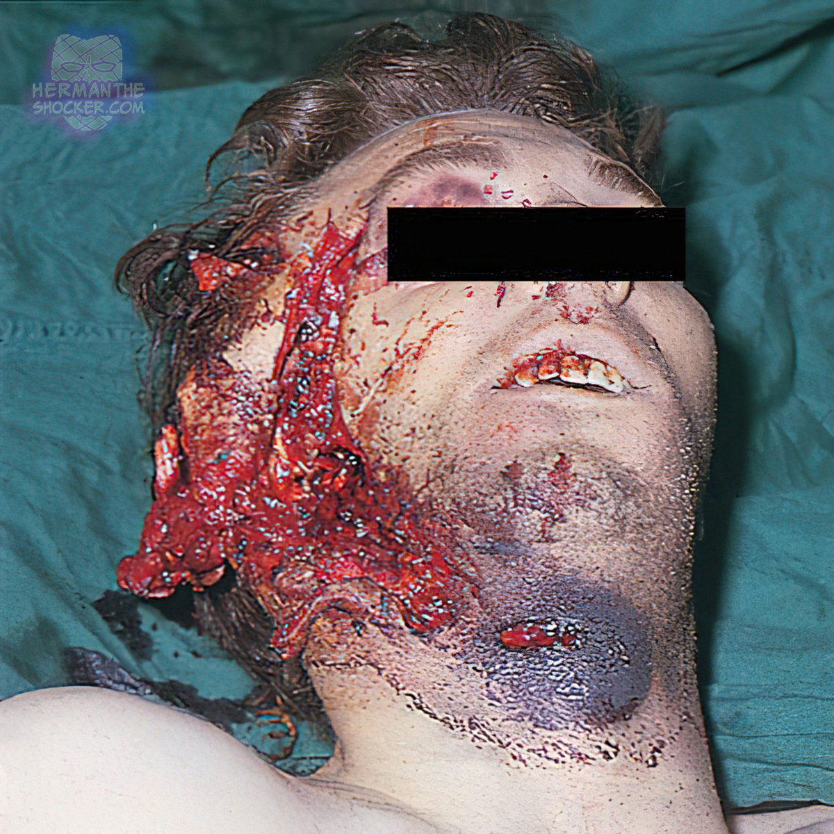 Suicidal discharge of a shotgun below the chin