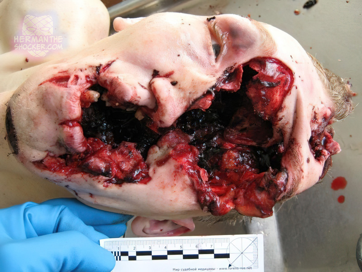 Suicide with a shotgun to the head