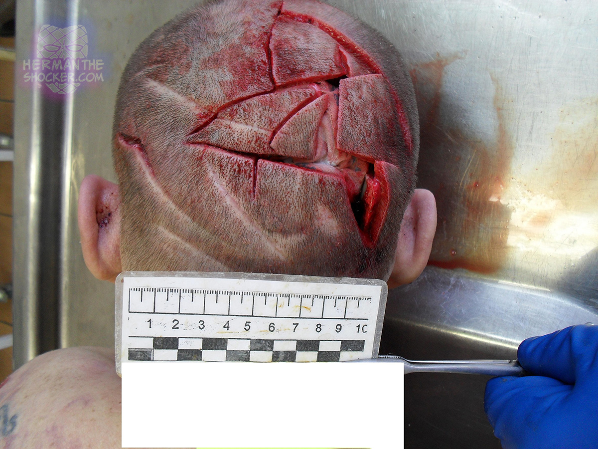 Homicidal chop wounds