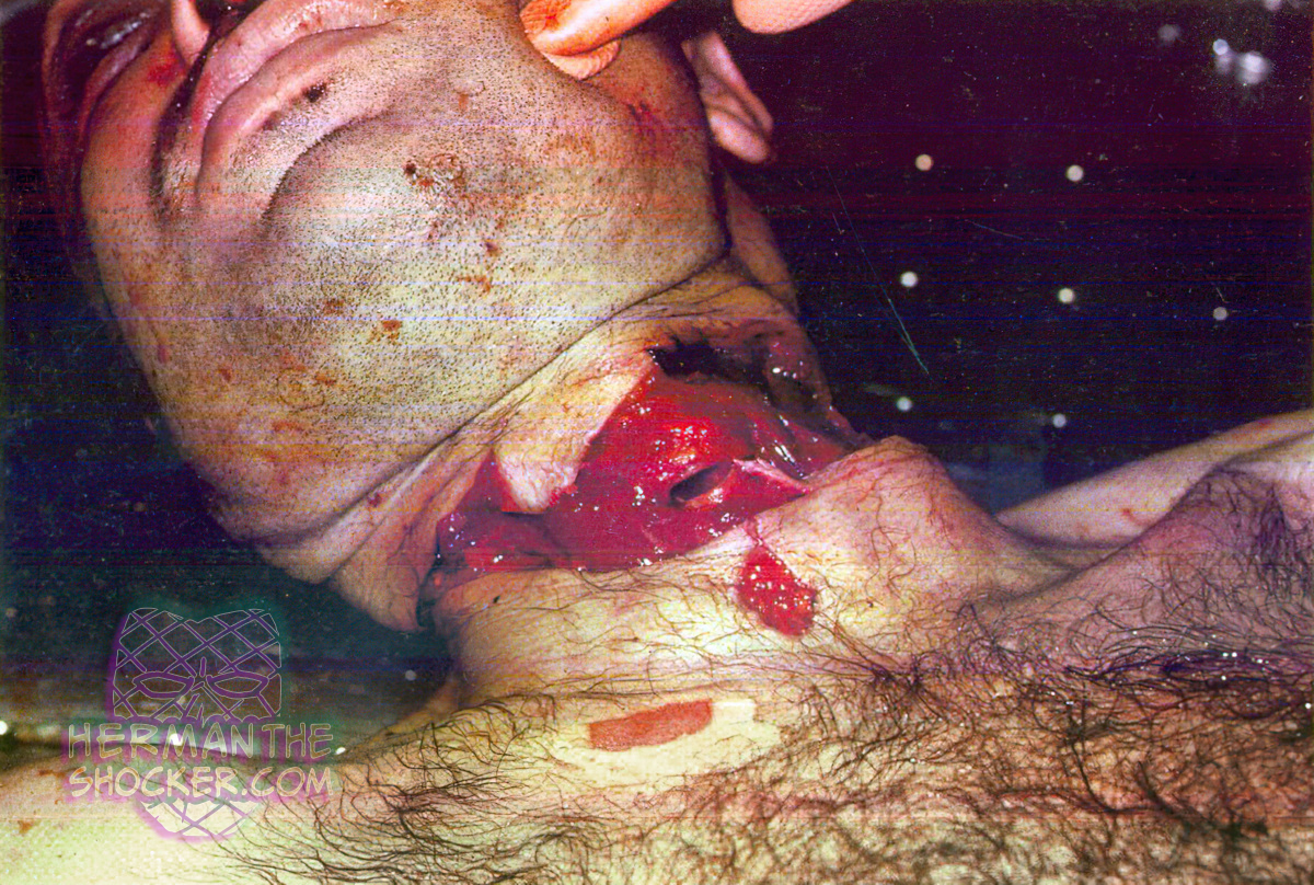 Suicidal throat cut