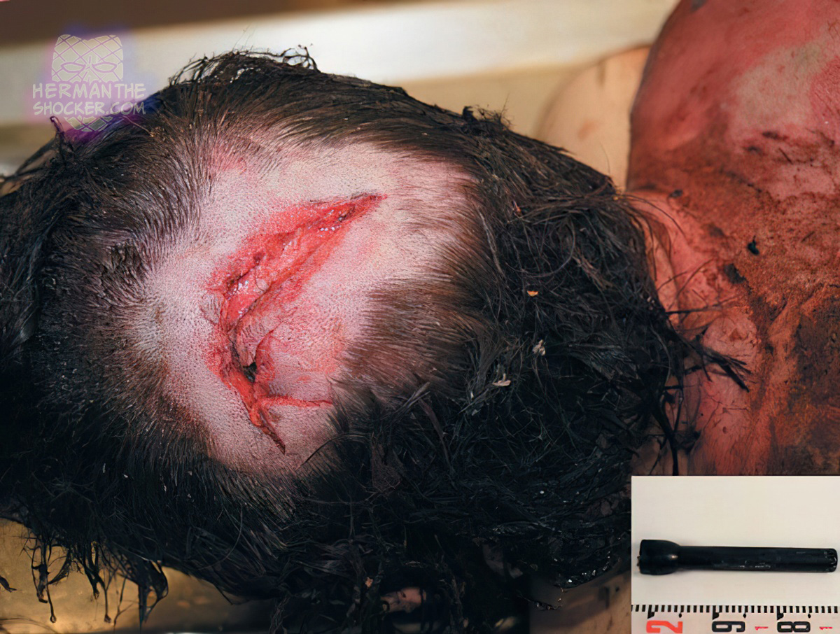 Laceration of the scalp from a heavy torch