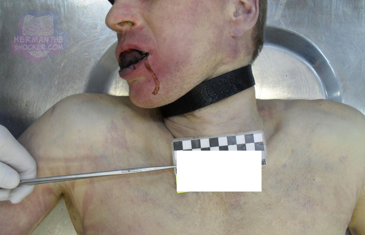 Suicide by hanging using a belt