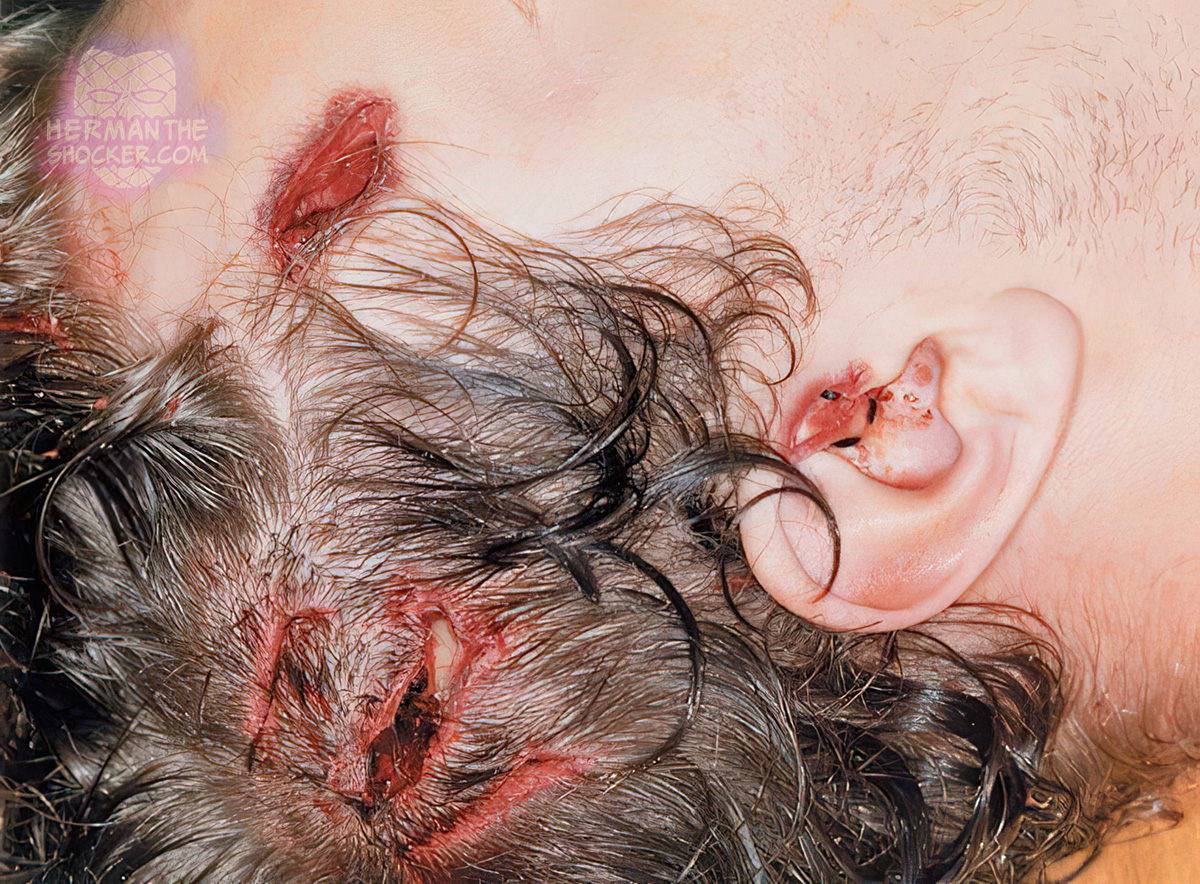 Homicidal lacerations of the scalp