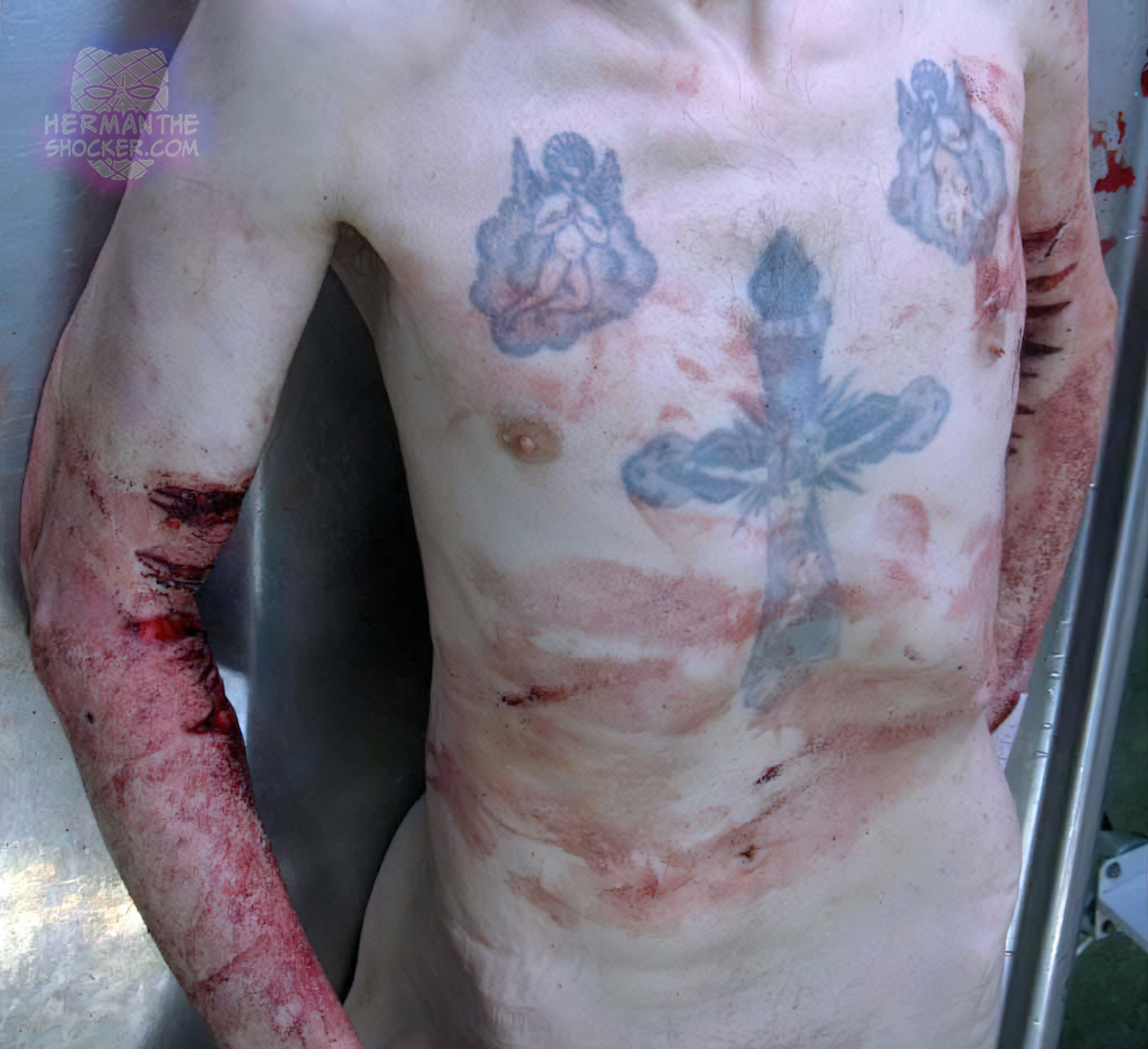 Suicide by cutting arms