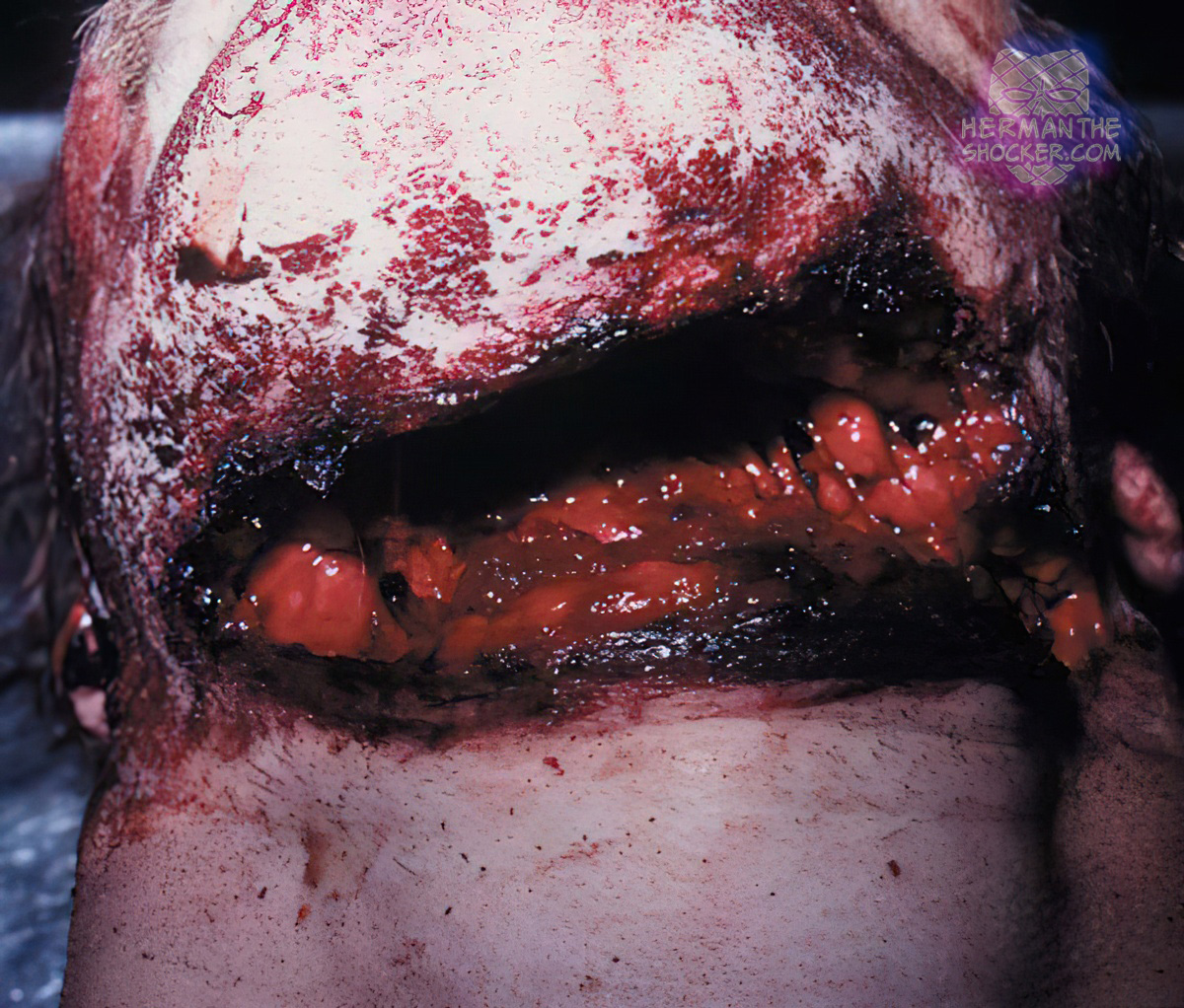 Mental patient commits suicide with a frame saw