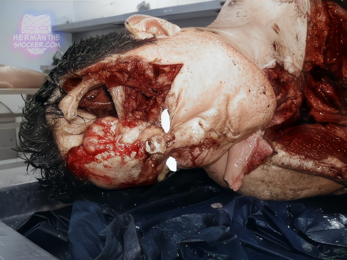 Crush injury to the skull and thorax