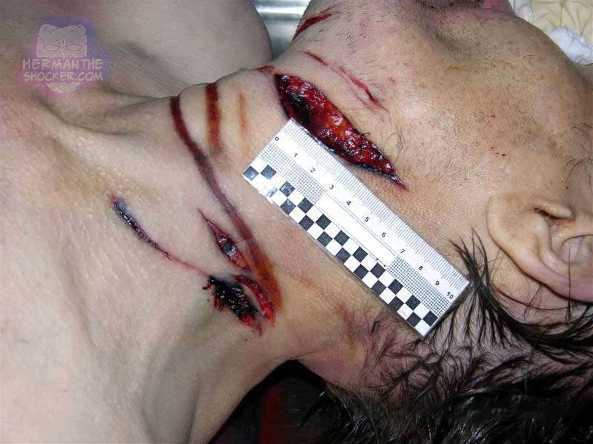 Cut throat and abrasions