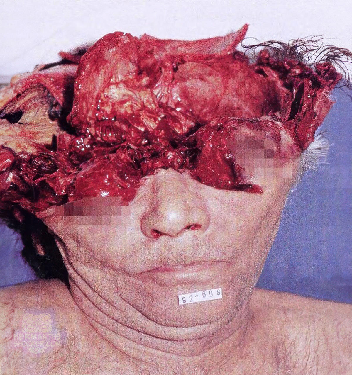 Explosive effect of a contact gunshot wound