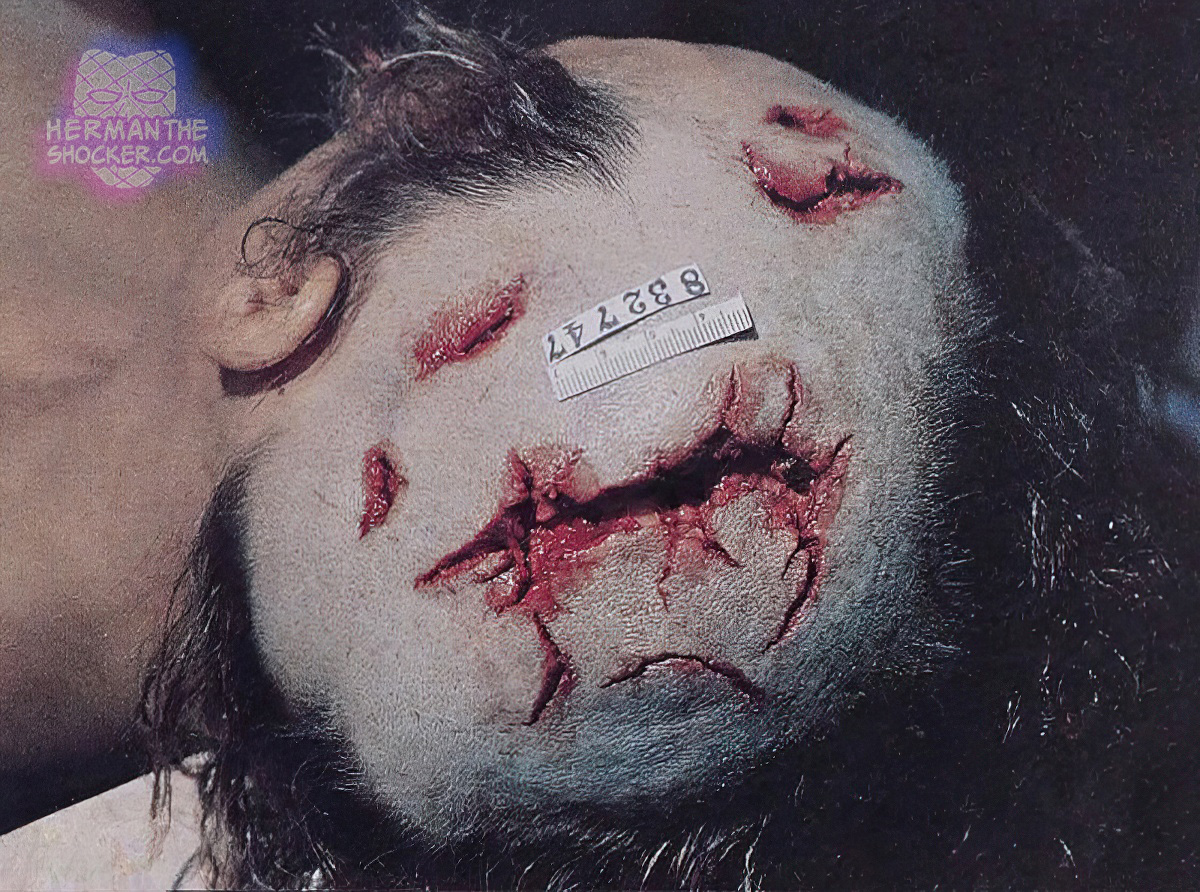 Lacerations inflicted by a claw hammer