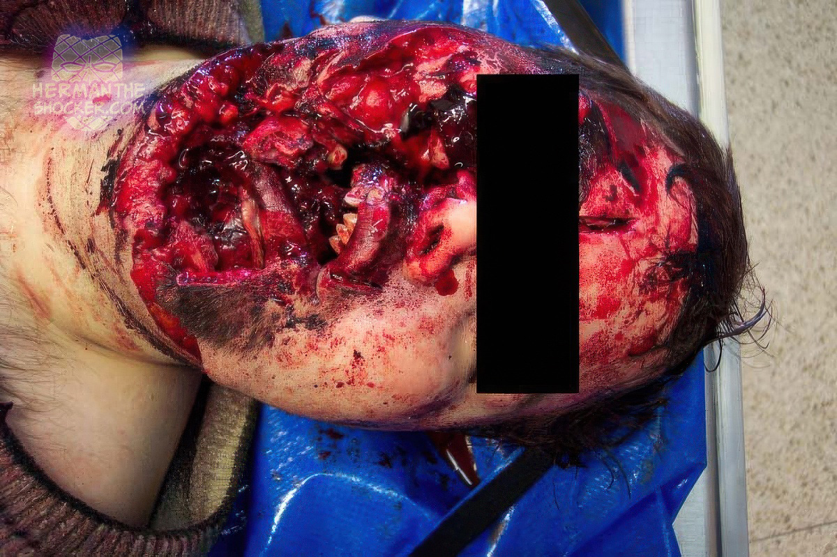 Shotgun suicide to the head