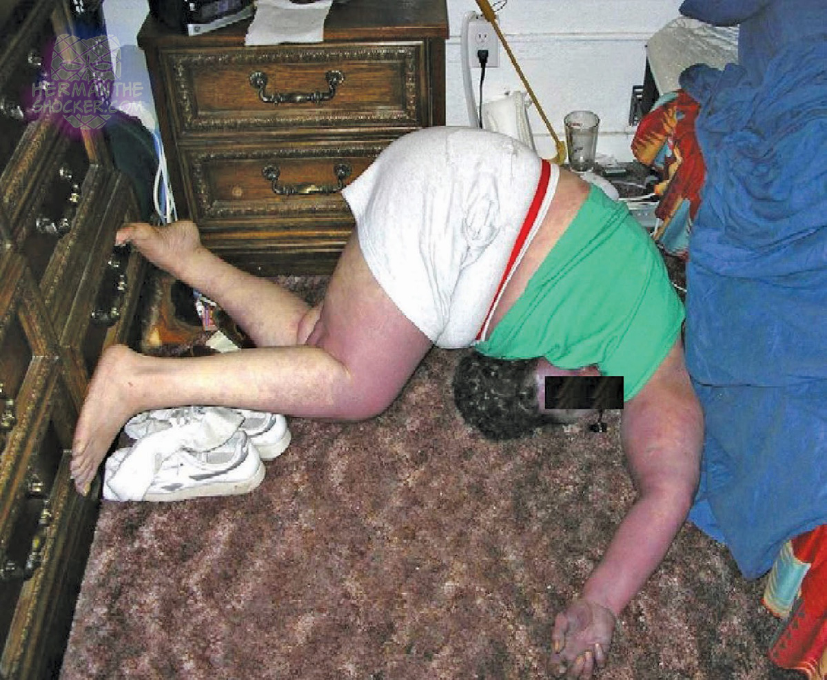 Positional asphyxia