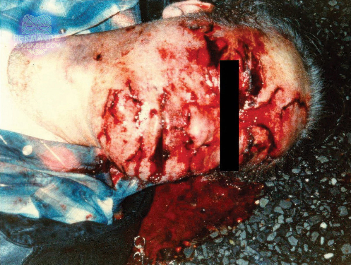 Blunt force trauma