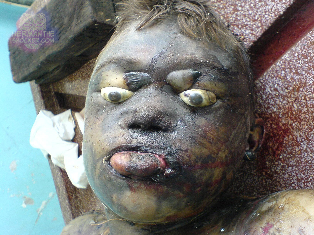 Bulging of the eyes, lips and face