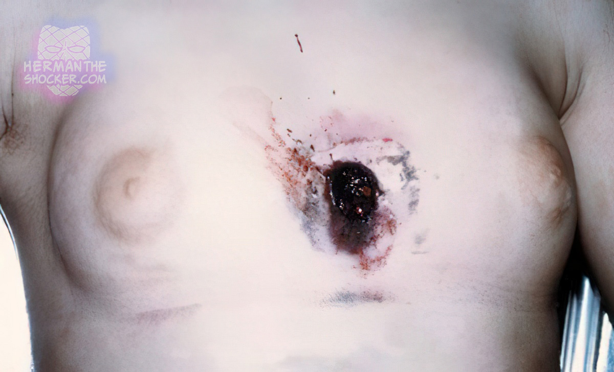 Suicidal firearm wound from a twelve-bore shotgun