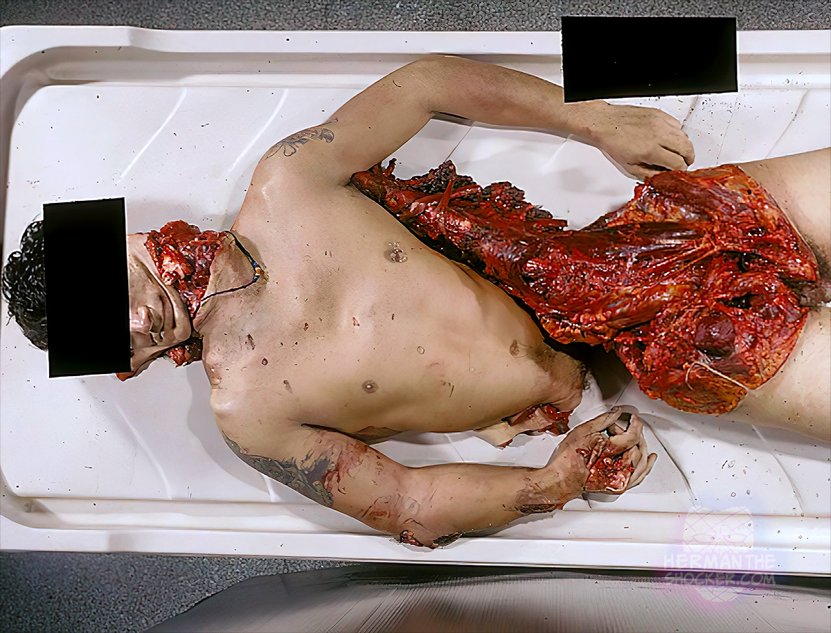 Complete body transection across abdomen and decapitation