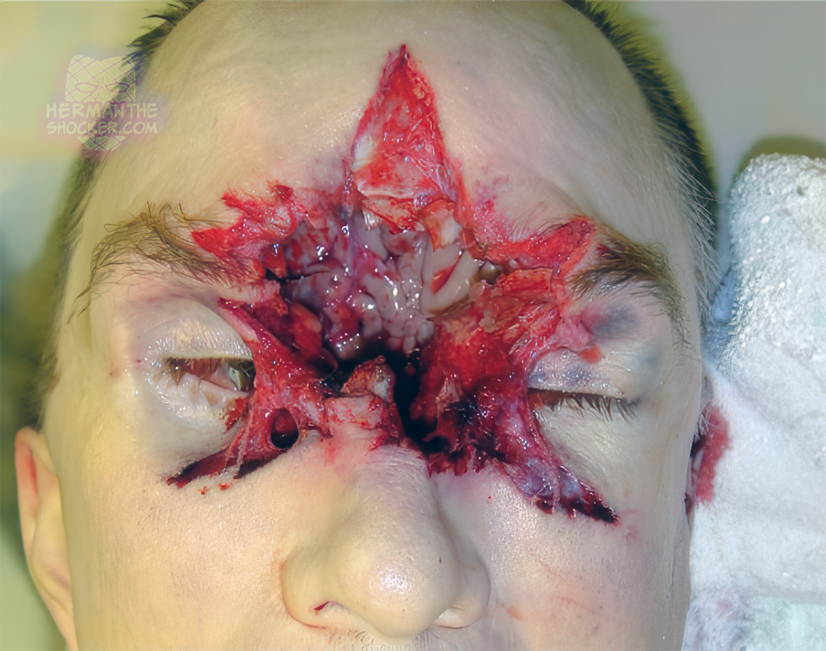 Contact wound between the eyes from a .357 Magnum revolver
