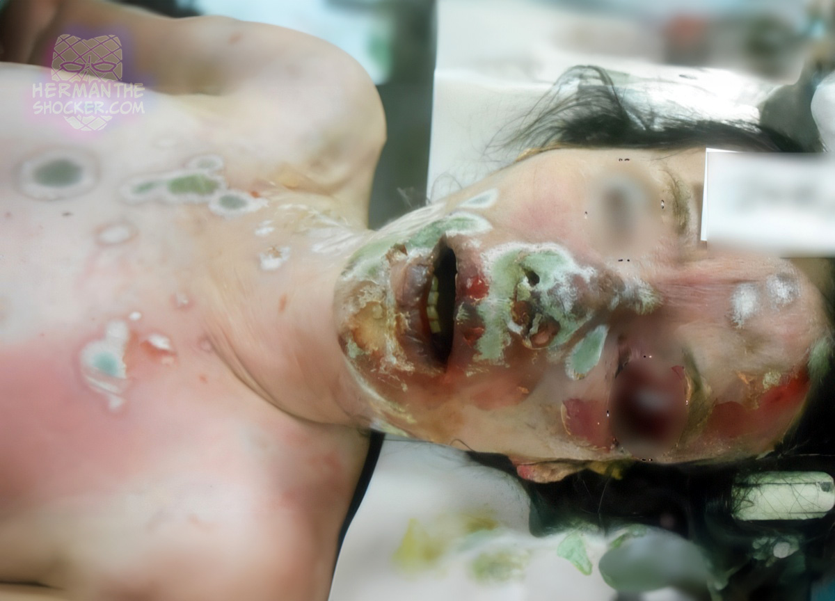 Fungal growth on a corpse