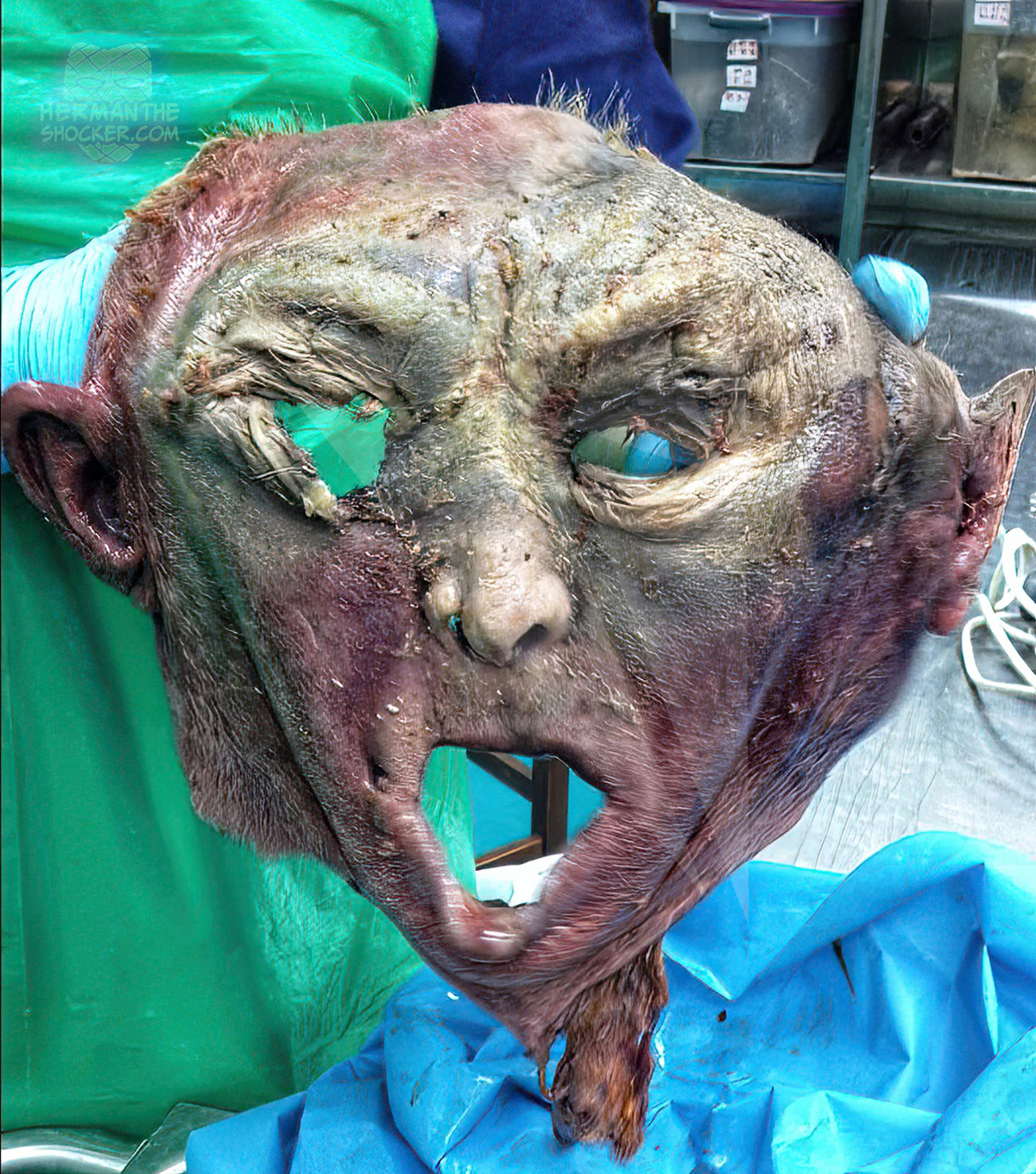 Cadaver face dissection