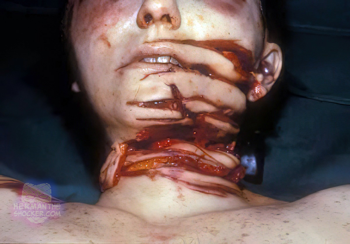 Incised wounds across the face and neck