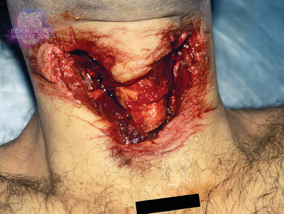 Self-inflicted wounds to the neck by a broken bottle