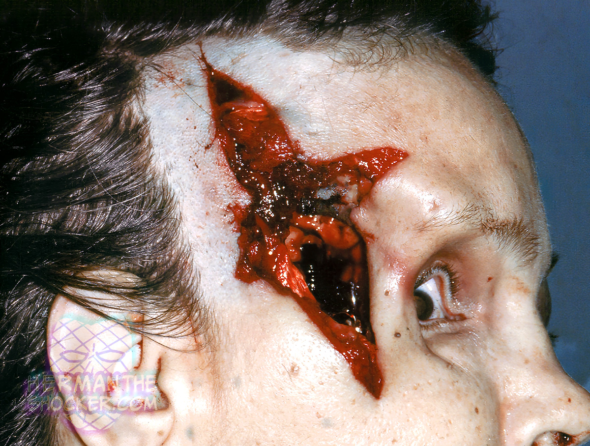 Contact gunshot wound of her right temple