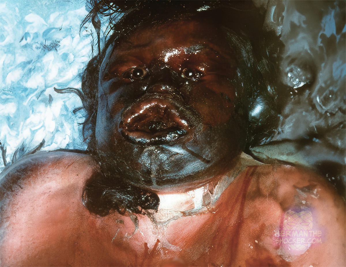 Putrefaction indoors in summertime after 60 hours since death