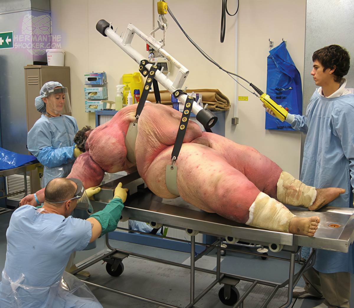 Morbidly obese bodies require special lifting devices