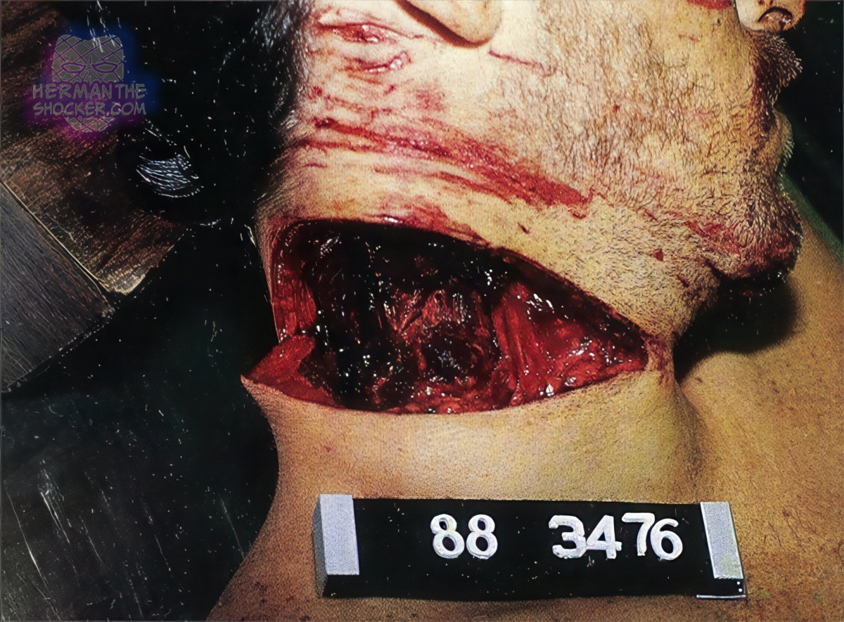Fatal incised wound of the neck