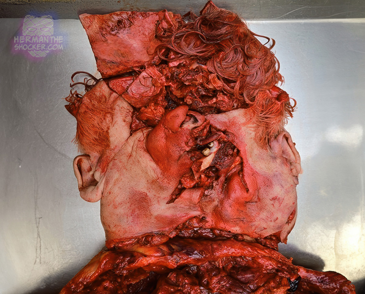 Incomplete decapitation with exenteration of the brain