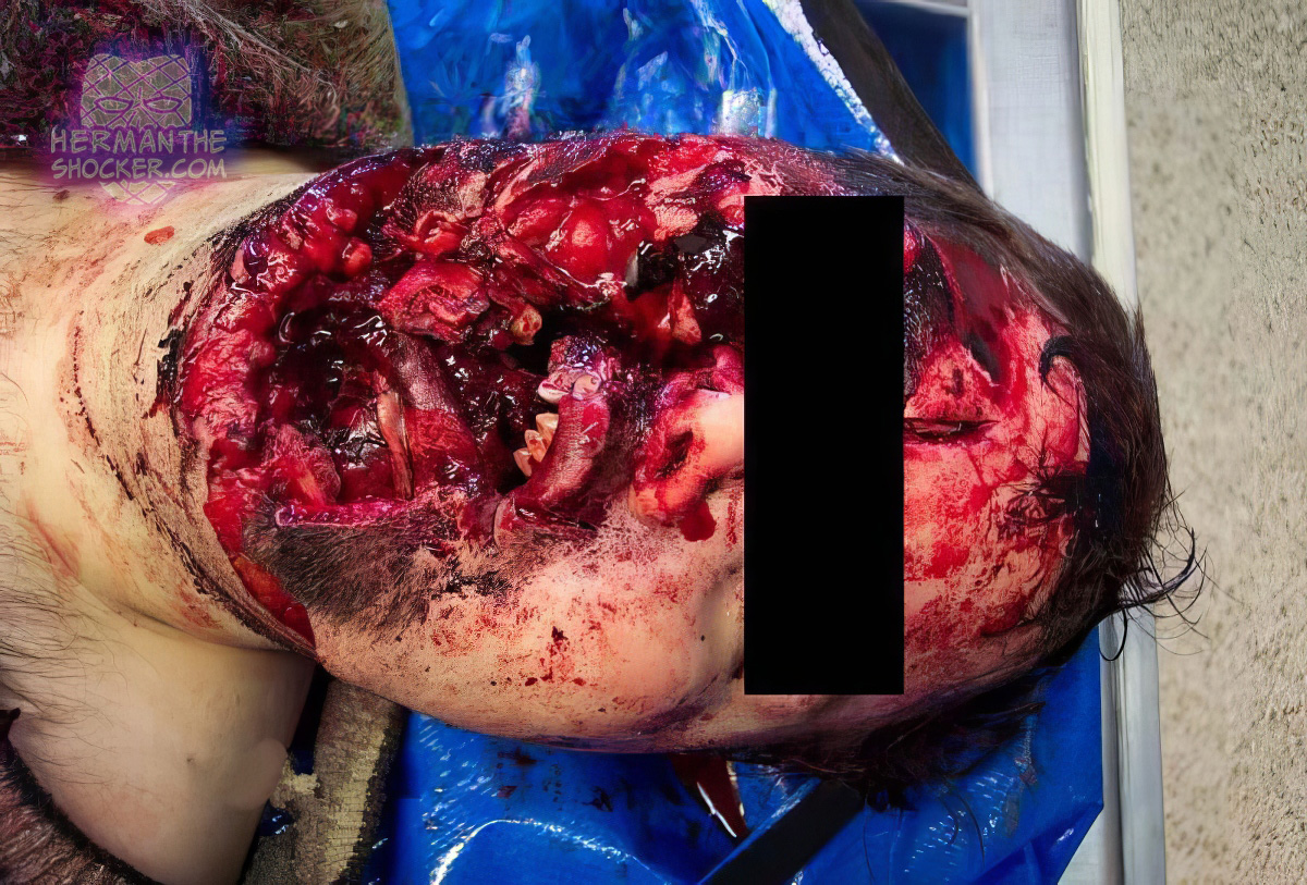 Shotgun gunshot wound to the head