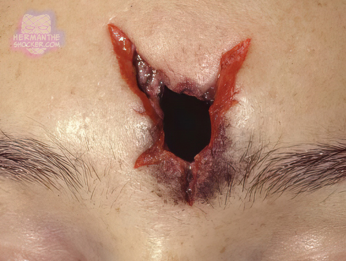 A hard contact entrance gunshot wound