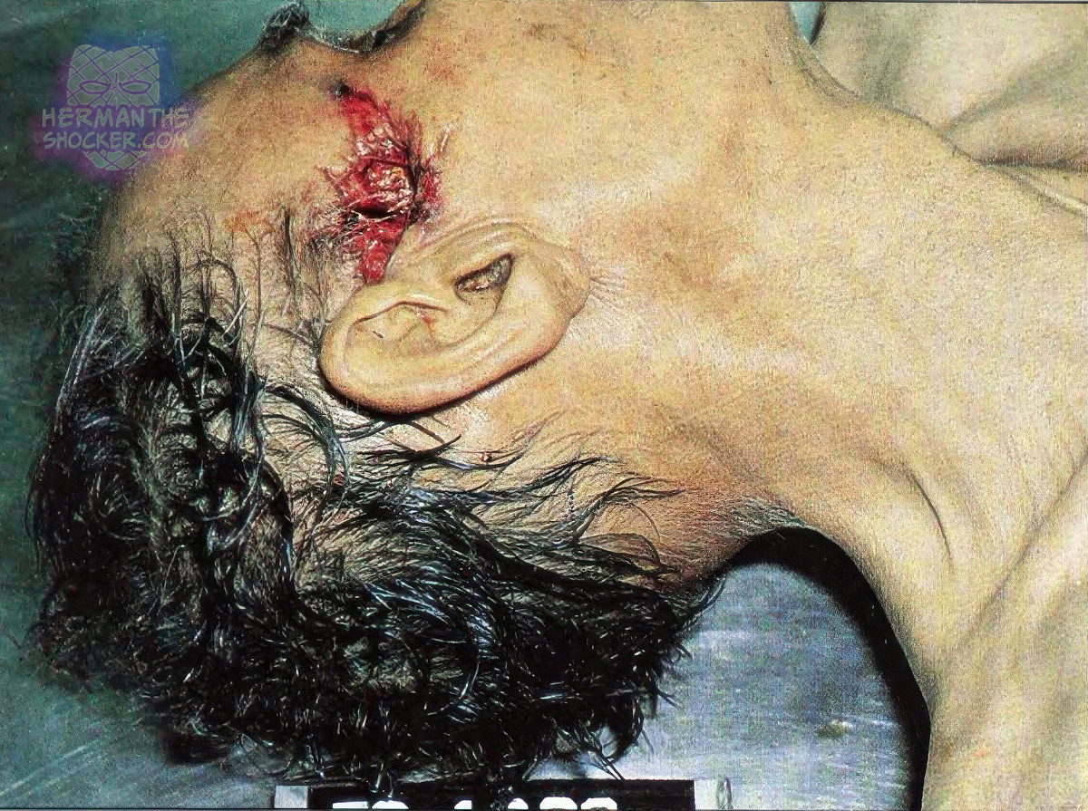 Contact entry gunshot wound