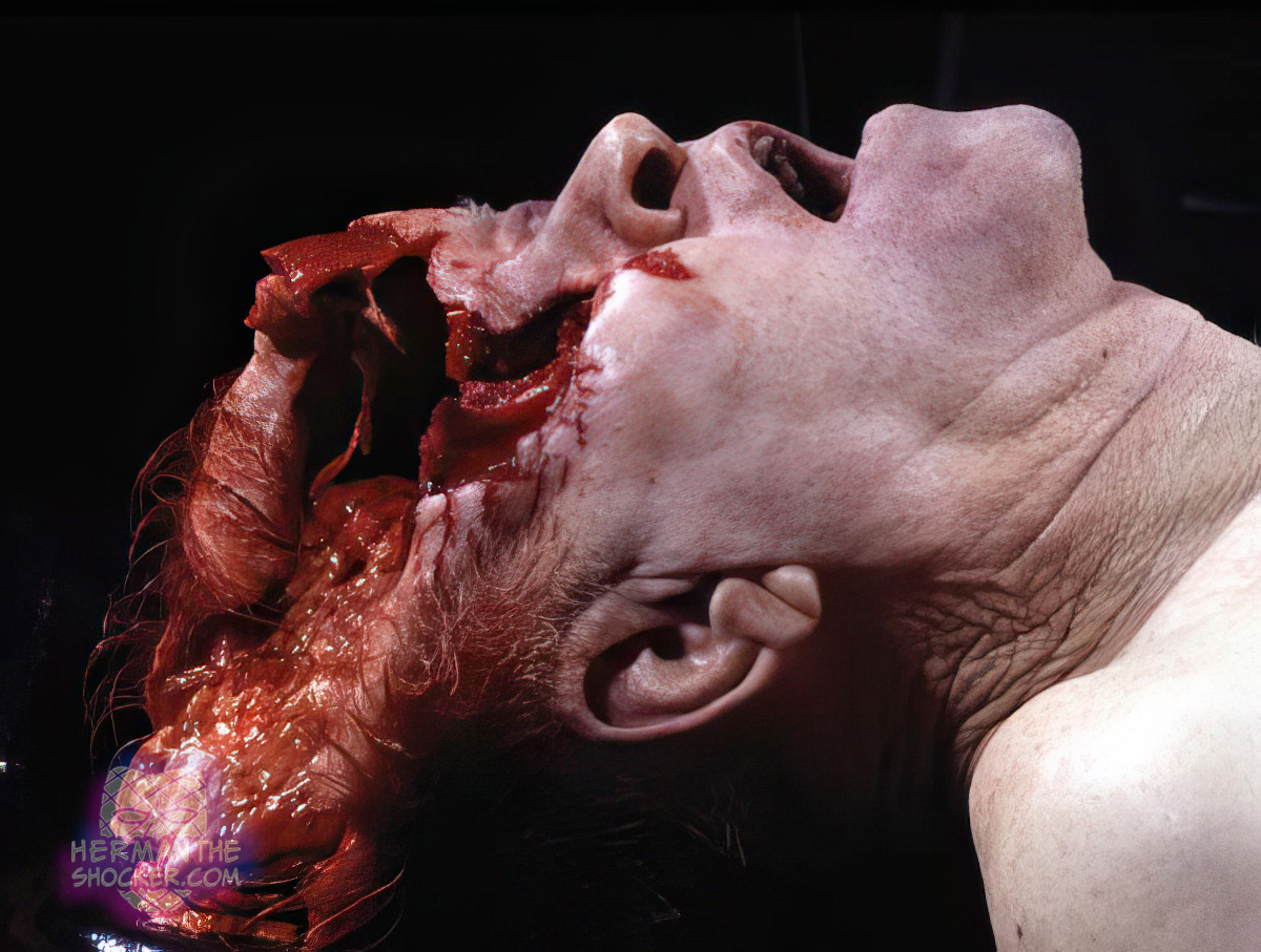 Intraoral 12-gauge shotgun wound to the head
