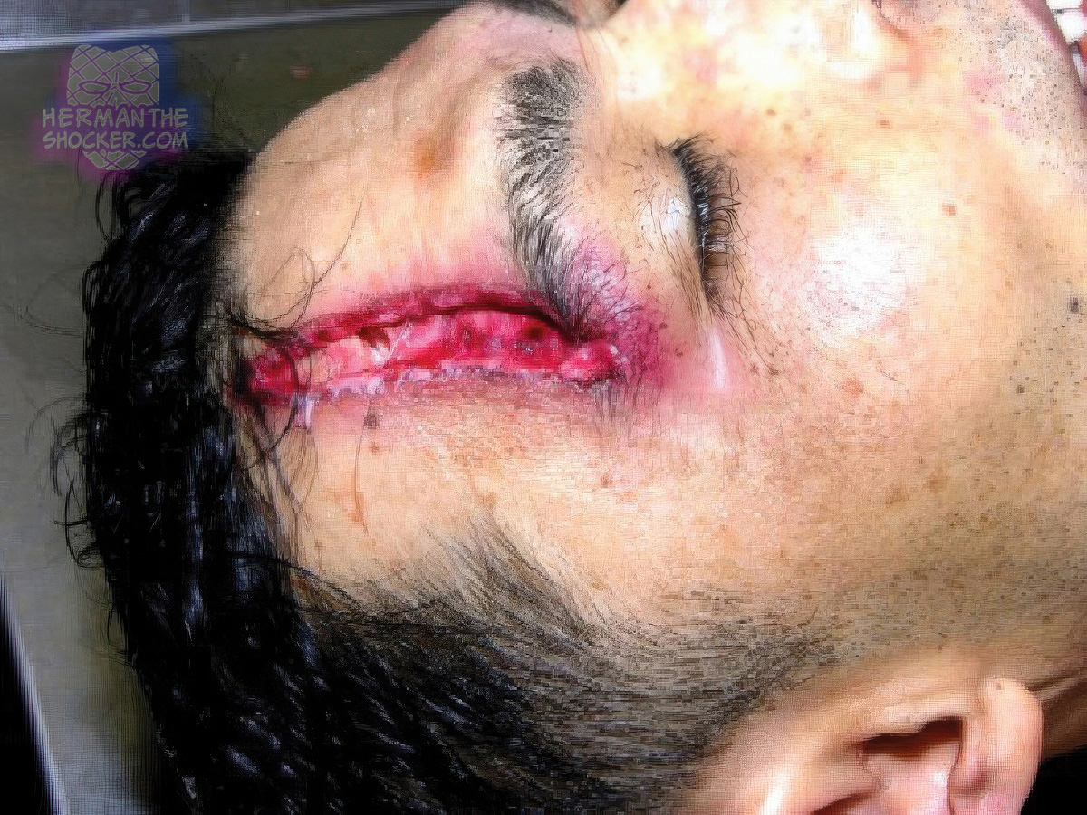 Bullet graze wound