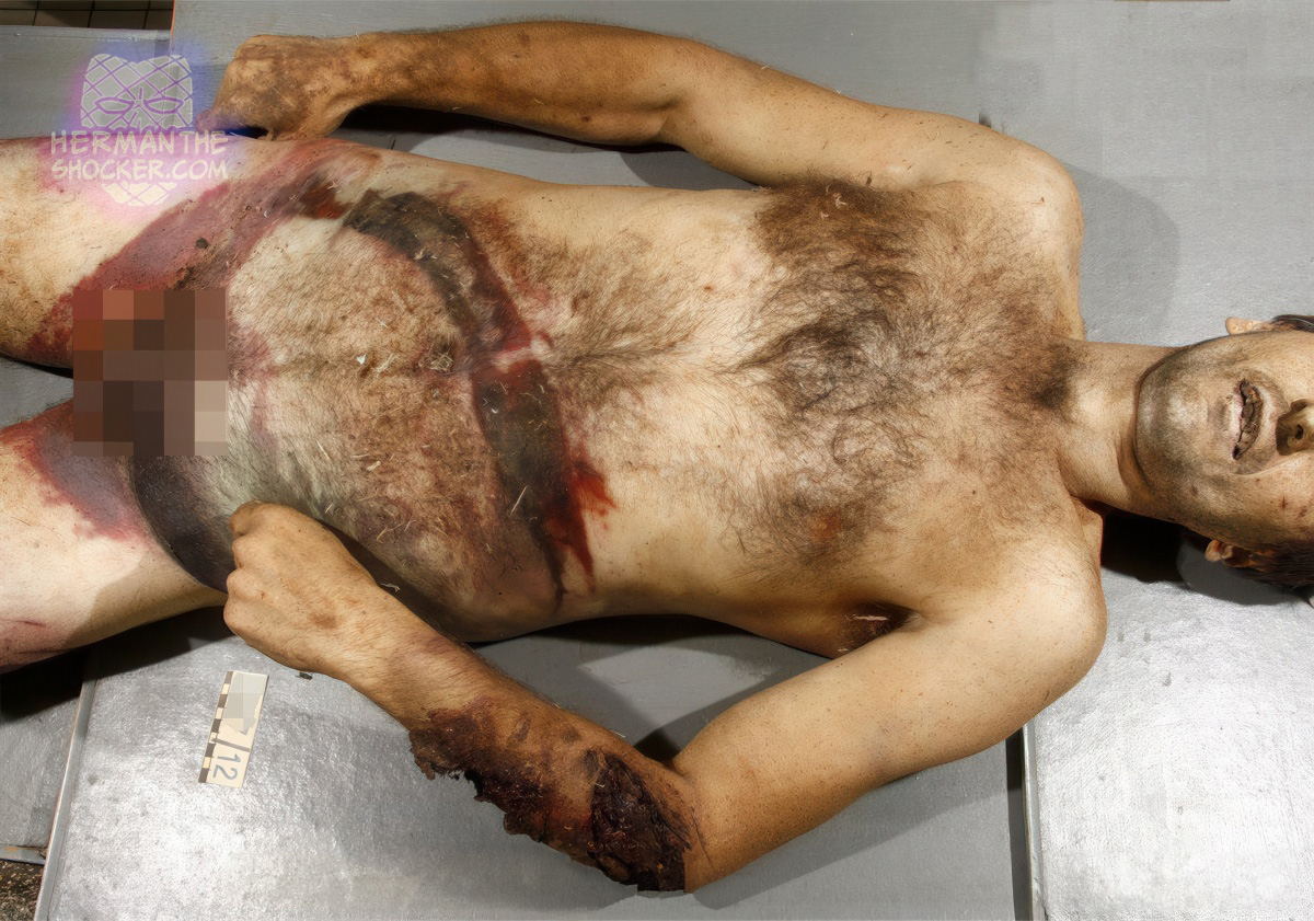 Blunt abdominal wounds