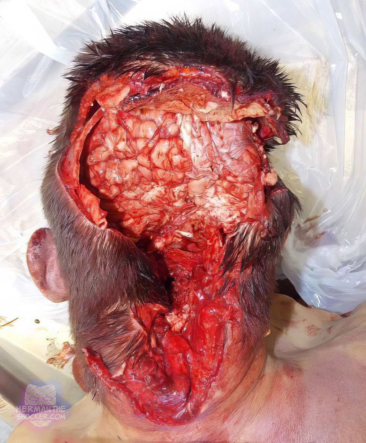 Suicide through the mouth with a rifle
