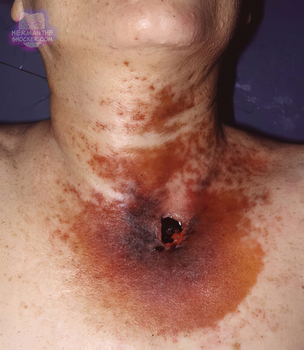 Stippling around an intermediate-range gunshot wound
