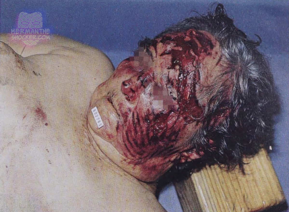 Fatal injuries after falling on an escalator